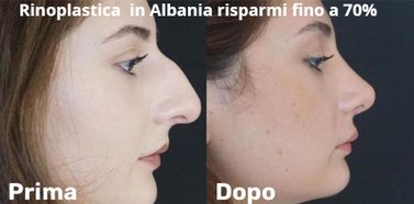 Rinoplastica in Albania